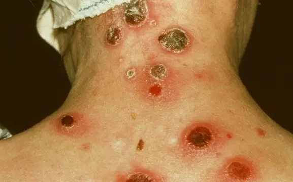 भेरी अस्पतालमा भिरिङ्गी रोगसम्बन्धी अनुसन्धान सुरु