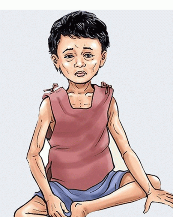 मधेशका १६ प्रतिशत बालबालिकामा कुपोषण