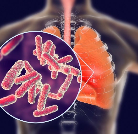 विश्वमा एक करोड सात लाख सक्रिय क्षयरोगी, नेपालका ४२ प्रतिशत उपचार बाहिर