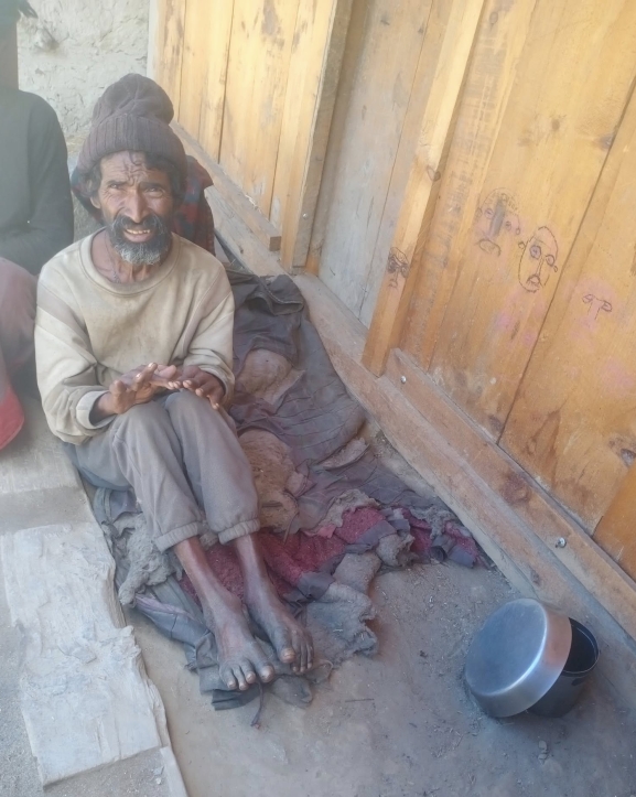 उपचारको पखाईमा कुष्ठरोग लागेका धनवीर