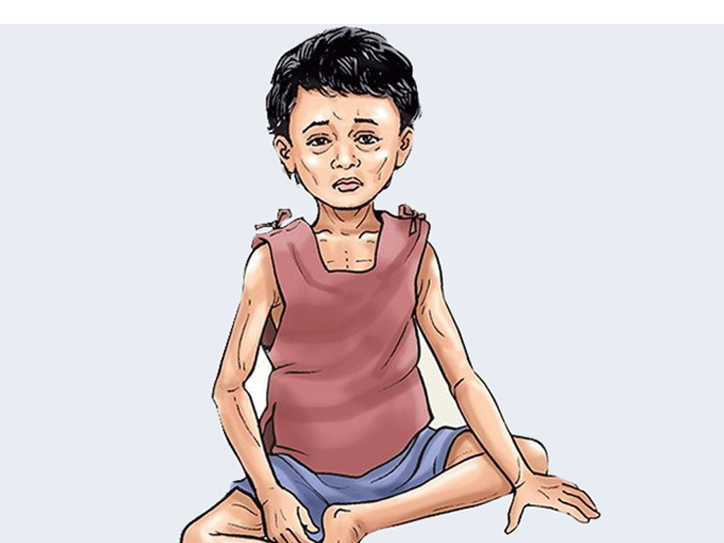 मधेशका १६ प्रतिशत बालबालिकामा कुपोषण
